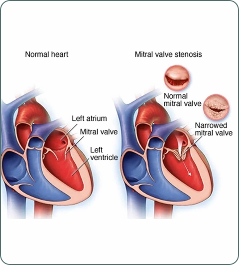 Heart and chest surgery illustration